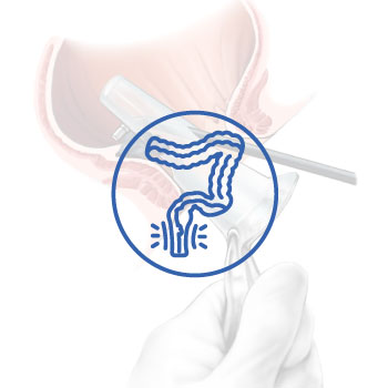 Endoscopic Hemorrhoid Band Legation