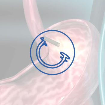 Percutaneous Endoscopic Gastrostomy